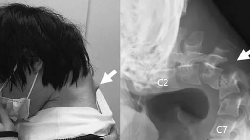 Thanh niên Nhật Bản mắc “hội chứng rụng đầu” do xem điện thoại quá nhiều, bác sĩ cảnh báo