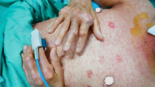 Ban đỏ toàn thân, môi lở loét vì tự ý uống thuốc nam không rõ nguồn gốc