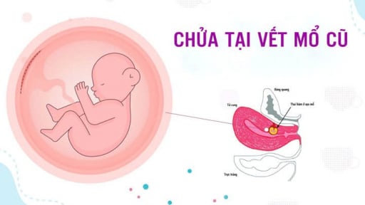 Vỡ thai, mất máu nghiêm trọng vì chửa tại vết mổ đẻ cũ