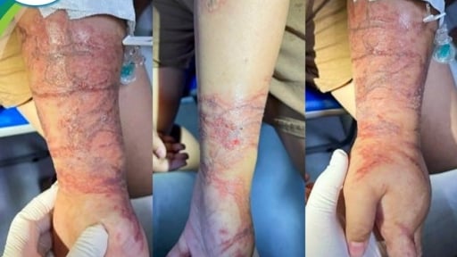 Hai tay bé gái đầy vết 'roi đánh' sưng đỏ sau khi chạm vào con vật này 