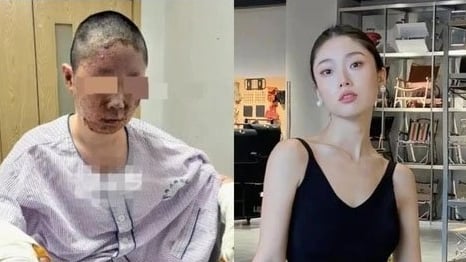 Người mẫu Đồng Dao biến dạng khuôn mặt sau vụ nổ kinh hoàng
