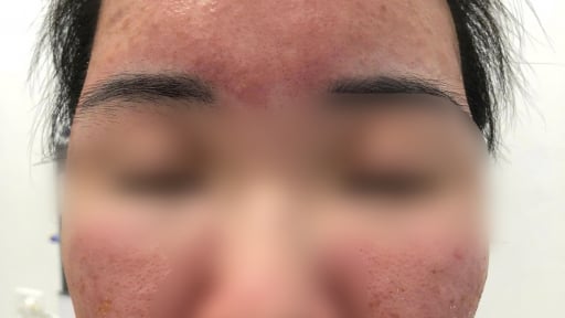 Nữ sinh cháy da vì tin lời quảng cáo kem 'siêu chống nắng' giá rẻ trên mạng