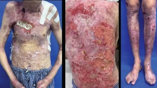 Thanh niên trợt loét toàn thân vì bệnh nặng mà không được chăm sóc đúng