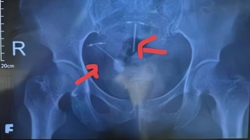 Bàng quang có sỏi lớn vì một 'dị vật' khó lường đi lạc
