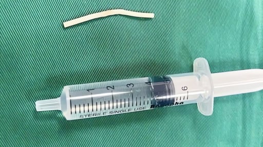 Bất ngờ khi que tránh thai 'đi lạc' chui sâu vào bắp tay
