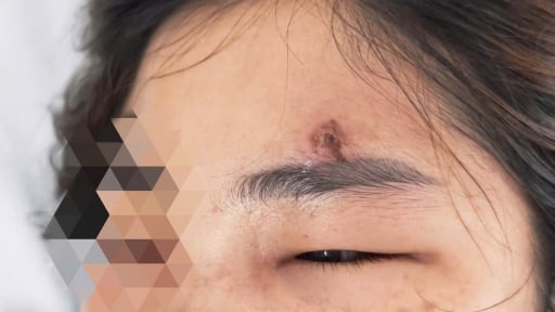 Cô gái sốt cao, trán sưng tấy, đau nhức dữ dội vì thói quen nhiều người mắc