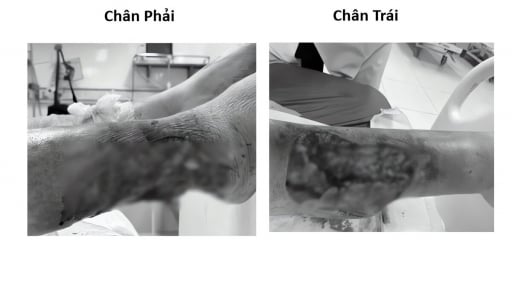 Cứu đôi chân lóc da không lành do biến chứng bệnh đái tháo đường nghiêm trọng