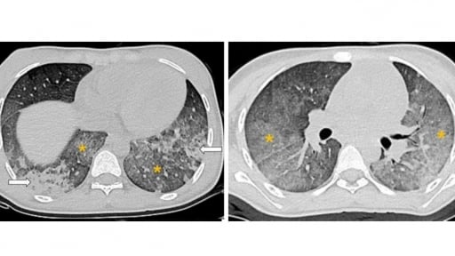 Mắc bệnh lupus ban đỏ, bé gái bất ngờ ho ra máu, suy tuần hoàn