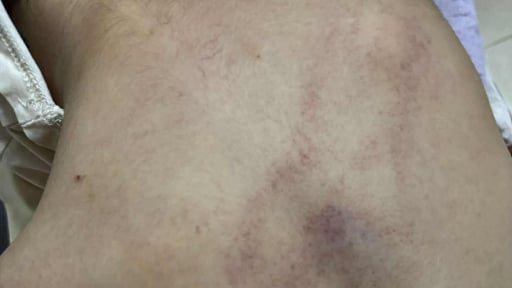 Chủ tịch phường Bồ Đề nói sẽ 'xử lý nghiêm' vụ bé gái 4 tuổi nghi bị cô giáo bạo hành tím lưng ở Hà Nội
