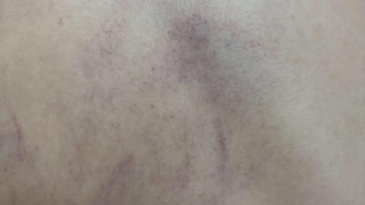 Vụ bé gái 4 tuổi ở Hà Nội bị cô giáo đánh tím lưng: Giáo viên thừa nhận đánh cháu bé