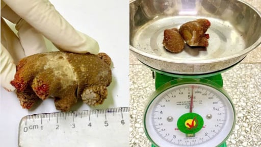 Sỏi thận khổng lồ như cục san hô lớn do trì hoãn điều trị