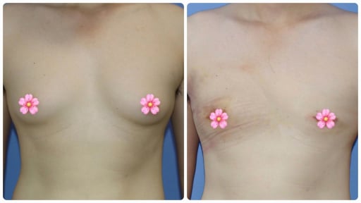 Xấu hổ, tự ti vì là 'đàn ông chính hiệu' lại có bộ ngực nở nang như chị em