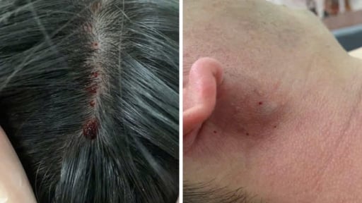 Xôn xao “chữa đột quỵ bằng cách chích máu ở đầu ngón tay và dái tai”, bác sĩ cảnh báo gì?