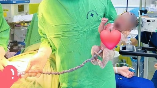 Kịp thời cứu sống trẻ sơ sinh có dây rốn dài bất thường, vặn xoắn nhiều vòng