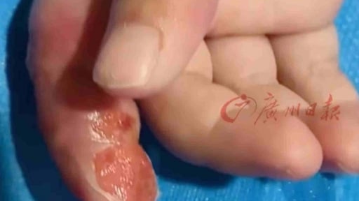 Mẹ quấn ngón tay con để ngăn mút tay, suýt phải cắt cụt