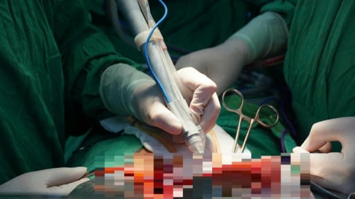 Bệnh viện đầu tiên tại miền Tây sử dụng hệ thống dao mổ siêu âm cắt gan cho bệnh nhân ung thư