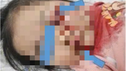Vô tình vặn ga xe máy khi mẹ lơ là, bé 26 tháng tuổi nguy kịch 
