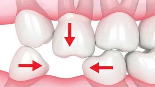 Mất răng số 6 và 7: Nguy cơ tiềm ẩn cho sức khỏe răng miệng