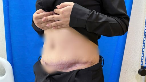 Hút mỡ bụng làm đẹp, người phụ nữ gặp biến chứng nguy hiểm