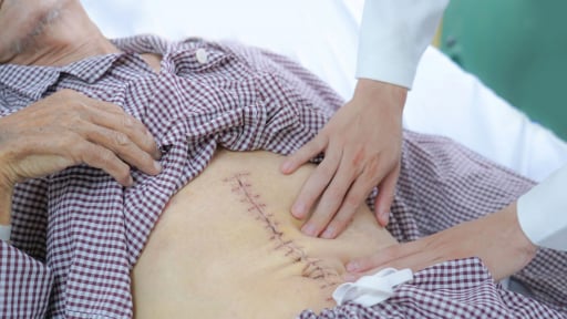 Cứu sống bệnh nh&acirc;n 67 tuổi mang 'quả bom hẹn giờ' ph&igrave;nh động mạch chủ bụng