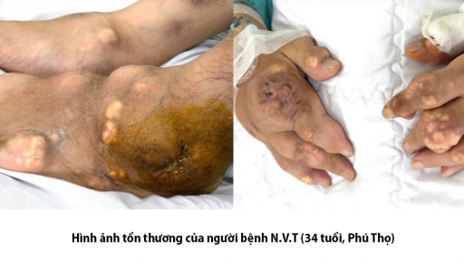 B&agrave;n tay, b&agrave;n ch&acirc;n biến dạng, lở lo&eacute;t, mặt căng tr&ograve;n v&igrave; tự &yacute; điều trị bệnh gout 