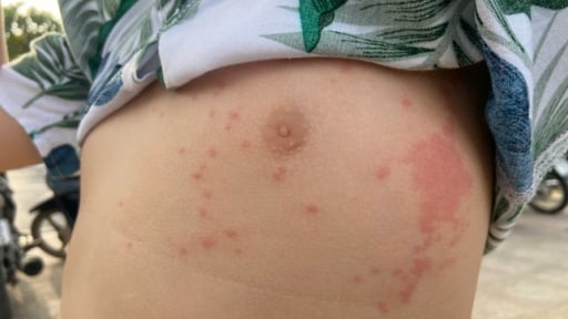Nhiều người bị sứa lửa 'tấn công' khi tắm biển Nha Trang