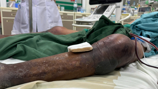 Lội đầm tôm bị gai đâm vào chân, một nông dân viêm mô bào, hoại tử chân lan rộng