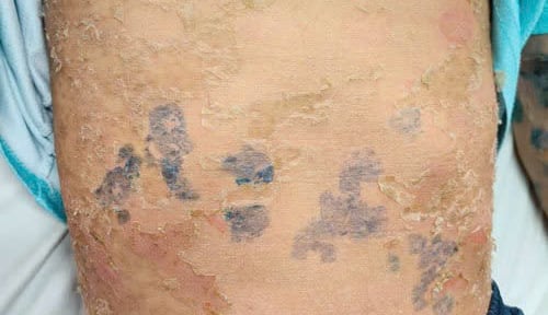 Toàn thân bị 'lột da' sau khi dùng lá tắm chữa bệnh sởi