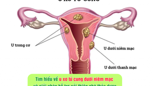 Tìm hiểu về u xơ tử cung dưới niêm mạc và giải pháp hỗ trợ cải thiện nhờ thảo dược