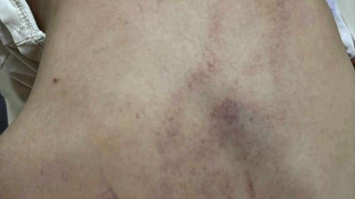 Bé gái mẫu giáo bị đánh tím lưng tại Hà Nội: Nghi bị cô giáo bạo hành