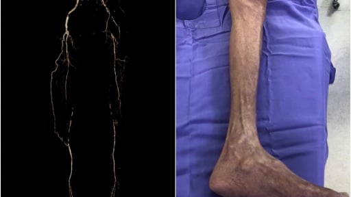 Trì hoãn đi viện do nghèo khó, suýt mất hai chân
