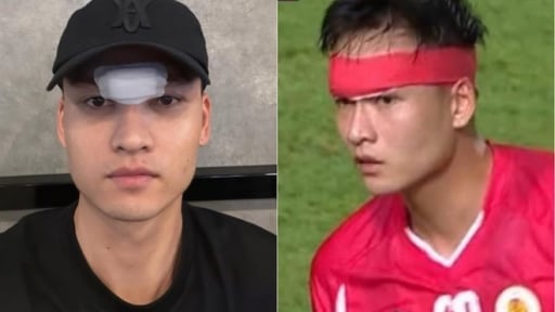 Bị ngoại binh BG Pathum United đạp thẳng vào mặt, Bùi Hoàng Việt Anh 1m86 khâu 14 mũi