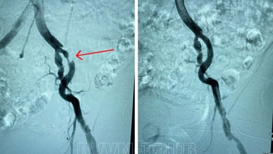 Suýt mất chân vì những triệu chứng đau nhức, tê bì 2 chân kéo dài