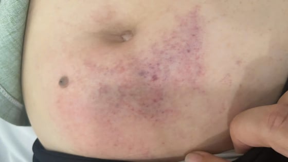 Hiệu phó trường mầm non ở Phú Quốc tố bị giáo viên đánh nhập viện