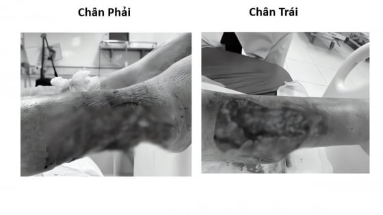 Cứu đôi chân lóc da không lành do biến chứng bệnh đái tháo đường nghiêm trọng