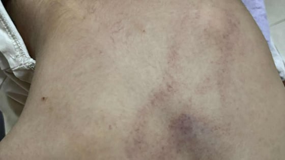 Chủ tịch phường Bồ Đề nói sẽ 'xử lý nghiêm' vụ bé gái 4 tuổi nghi bị cô giáo bạo hành tím lưng ở Hà Nội