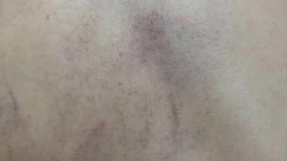 Vụ bé gái 4 tuổi ở Hà Nội bị cô giáo đánh tím lưng: Giáo viên thừa nhận đánh cháu bé