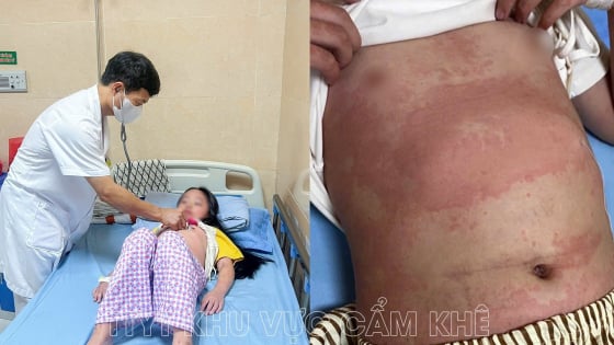 Nhiều trẻ phát ban, sẩn ngứa, bác sĩ cảnh báo bệnh mùa hè