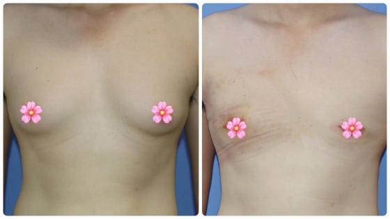Xấu hổ, tự ti vì là 'đàn ông chính hiệu' lại có bộ ngực nở nang như chị em