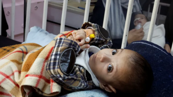 Liên Hợp Quốc: Mỗi ngày 10 trẻ em bị mất chân vì chiến sự ở Gaza