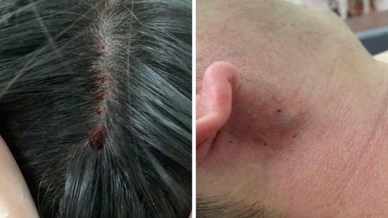 Xôn xao “chữa đột quỵ bằng cách chích máu ở đầu ngón tay và dái tai”, bác sĩ cảnh báo gì?