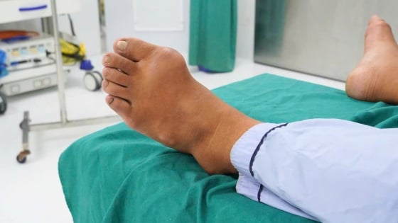 Thanh niên 31 tuổi đã sưng tấy khớp, đau đớn vì căn bệnh tưởng chỉ ở người già