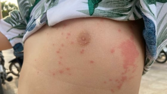 Nhiều người bị sứa lửa 'tấn công' khi tắm biển Nha Trang