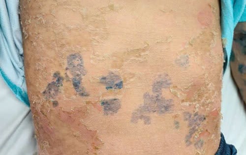 Toàn thân bị 'lột da' sau khi dùng lá tắm chữa bệnh sởi
