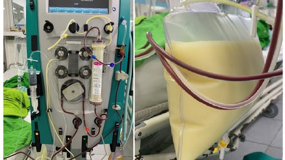 Sốc: Lọc được bịch mỡ từ máu của cô gái nặng 45kg, chỉ số mỡ máu cao gấp 37 lần