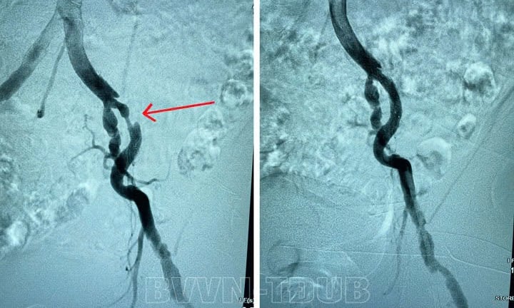 Suýt mất chân vì những triệu chứng đau nhức, tê bì 2 chân kéo dài