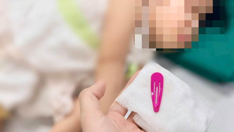 Phụ huynh hoảng hồn khi 'khối nghỉ hè' nuốt phải kẹp tóc dài 5cm trong dạ dày
