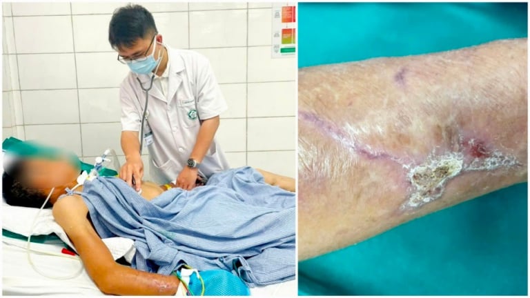 Co cứng toàn thân, suy hô hấp vì vết thương ngoài da 'tưởng nhẹ'