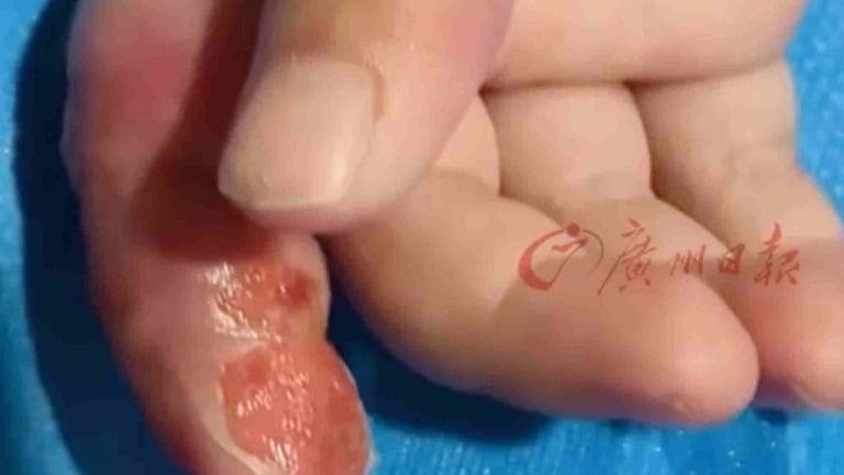 Mẹ quấn ngón tay con để ngăn mút tay, suýt phải cắt cụt