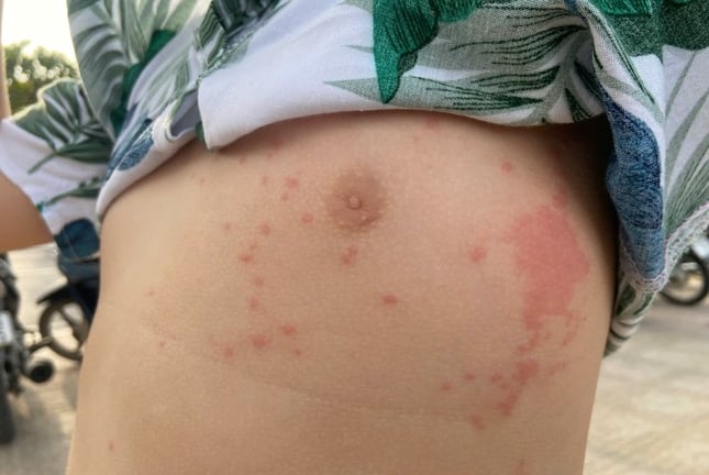 Nhiều người bị sứa lửa 'tấn công' khi tắm biển Nha Trang
